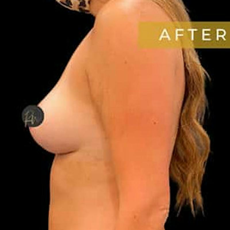Breast Lift Before & After Gallery - Patient 131852 - Image 4