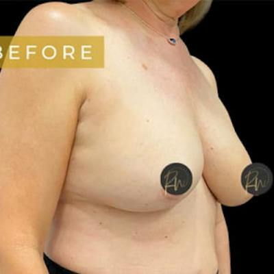 Breast Lift Before & After Gallery - Patient 867553 - Image 1
