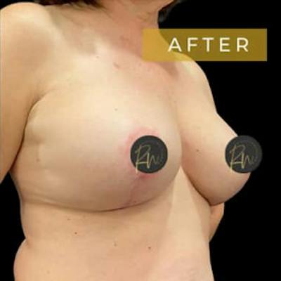 Breast Lift Before & After Gallery - Patient 867553 - Image 2