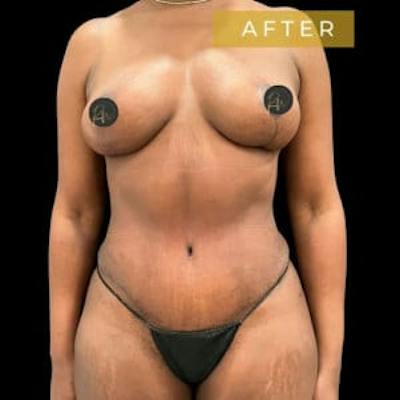 Abdominoplasty (Tummy Tuck) Before & After Gallery - Patient 787471 - Image 2