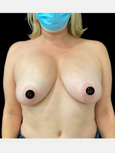 Breast Revision/Correction Before & After Gallery - Patient 169772 - Image 1