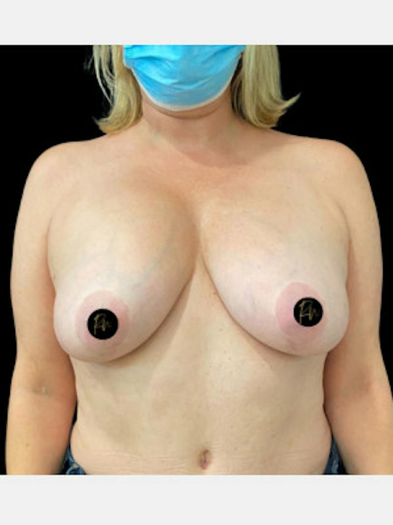 Breast Revision/Correction Before & After Gallery - Patient 169772 - Image 1
