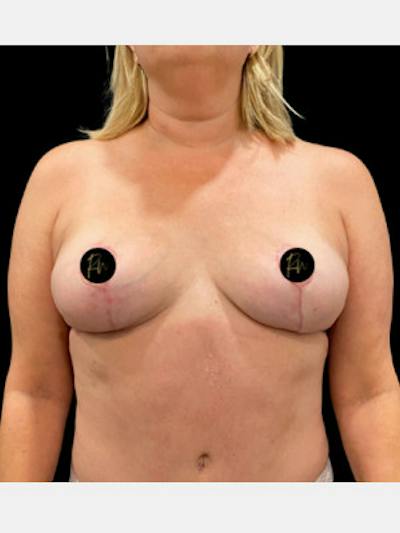 Breast Revision/Correction Before & After Gallery - Patient 169772 - Image 2