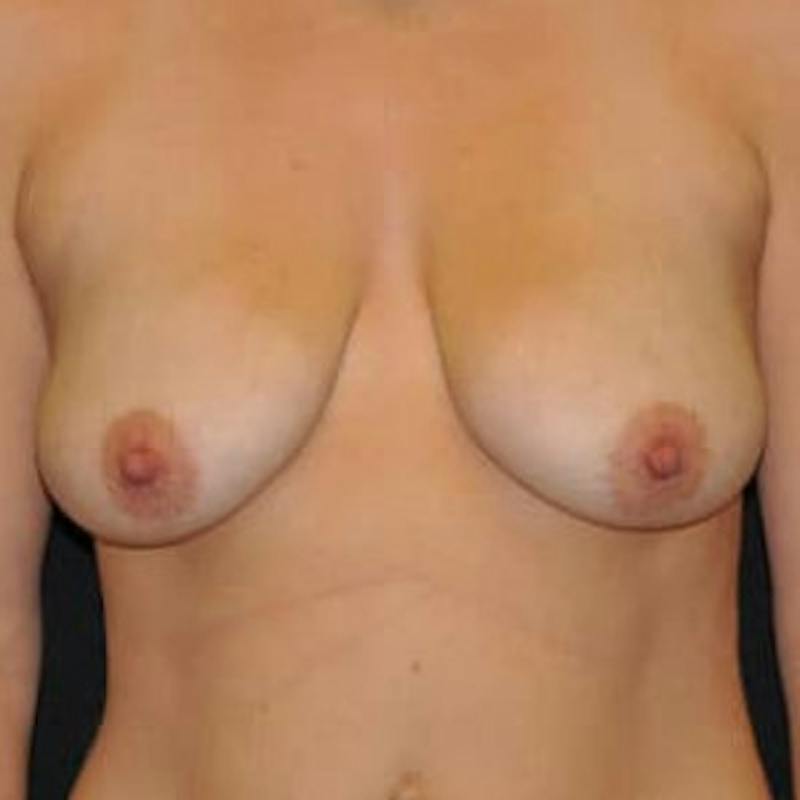 Breast Lift Before & After Gallery - Patient 333627 - Image 1