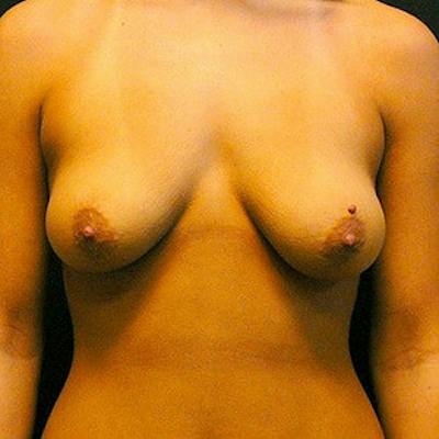 Breast Lift Before & After Gallery - Patient 753755 - Image 1