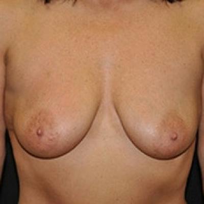 Breast Lift Before & After Gallery - Patient 175431 - Image 1