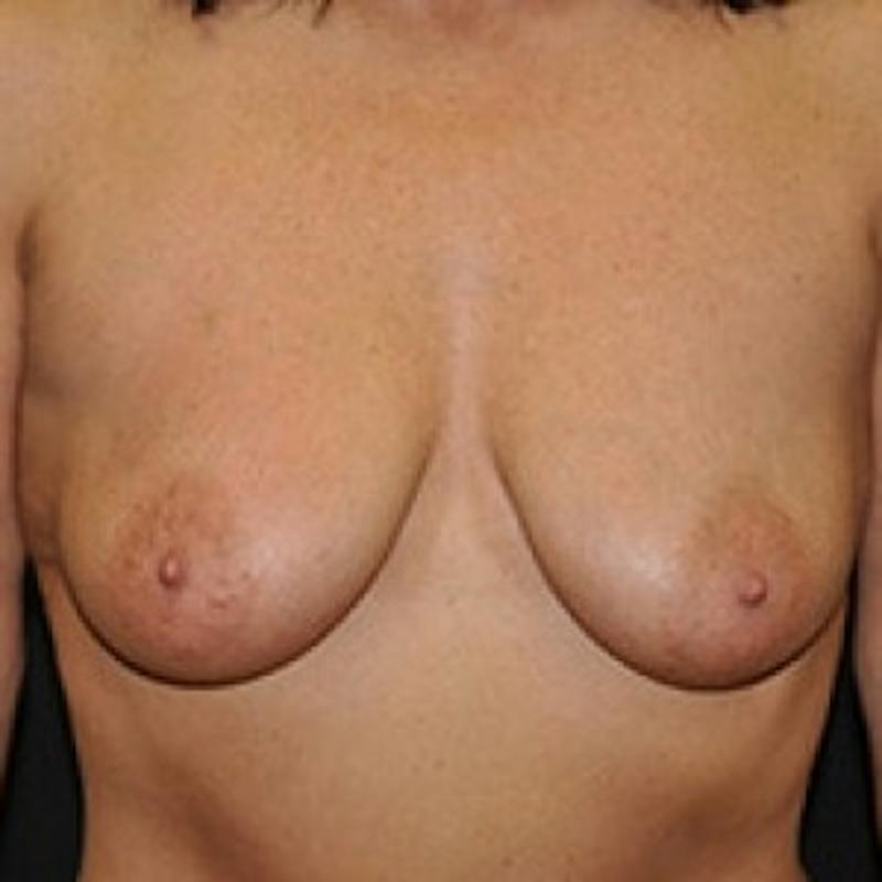 Breast Lift Before & After Gallery - Patient 175431 - Image 1