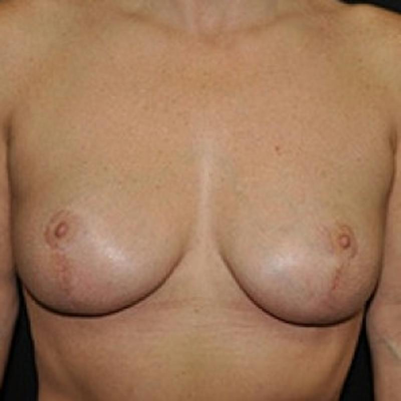 Breast Lift Before & After Gallery - Patient 175431 - Image 2
