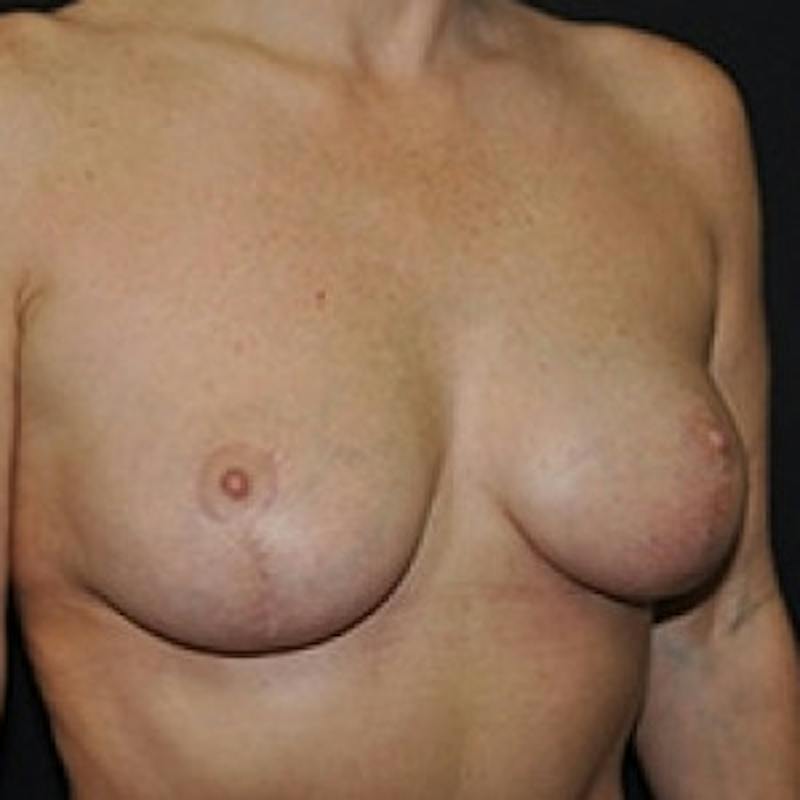 Breast Lift Before & After Gallery - Patient 175431 - Image 4