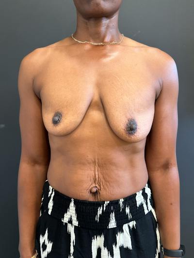Breast Lift w/ Augmentation Before & After Gallery - Patient 127582 - Image 1