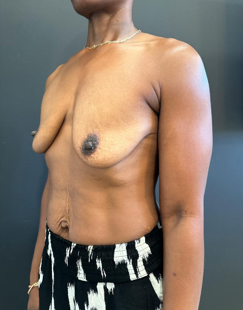 Breast Lift w/ Augmentation Before & After Gallery - Patient 127582 - Image 3