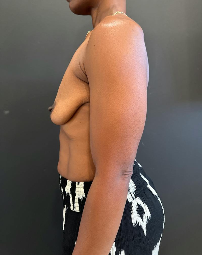 Breast Lift w/ Augmentation Before & After Gallery - Patient 127582 - Image 5