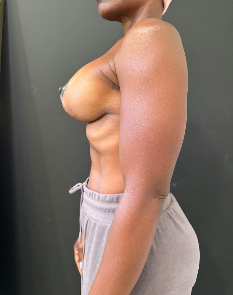 Breast Lift w/ Augmentation Before & After Gallery - Patient 127582 - Image 6