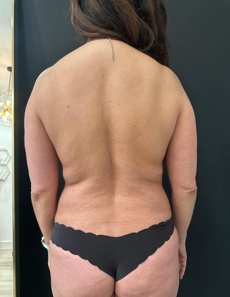 SAFElipo Before & After Gallery - Patient 172783 - Image 5
