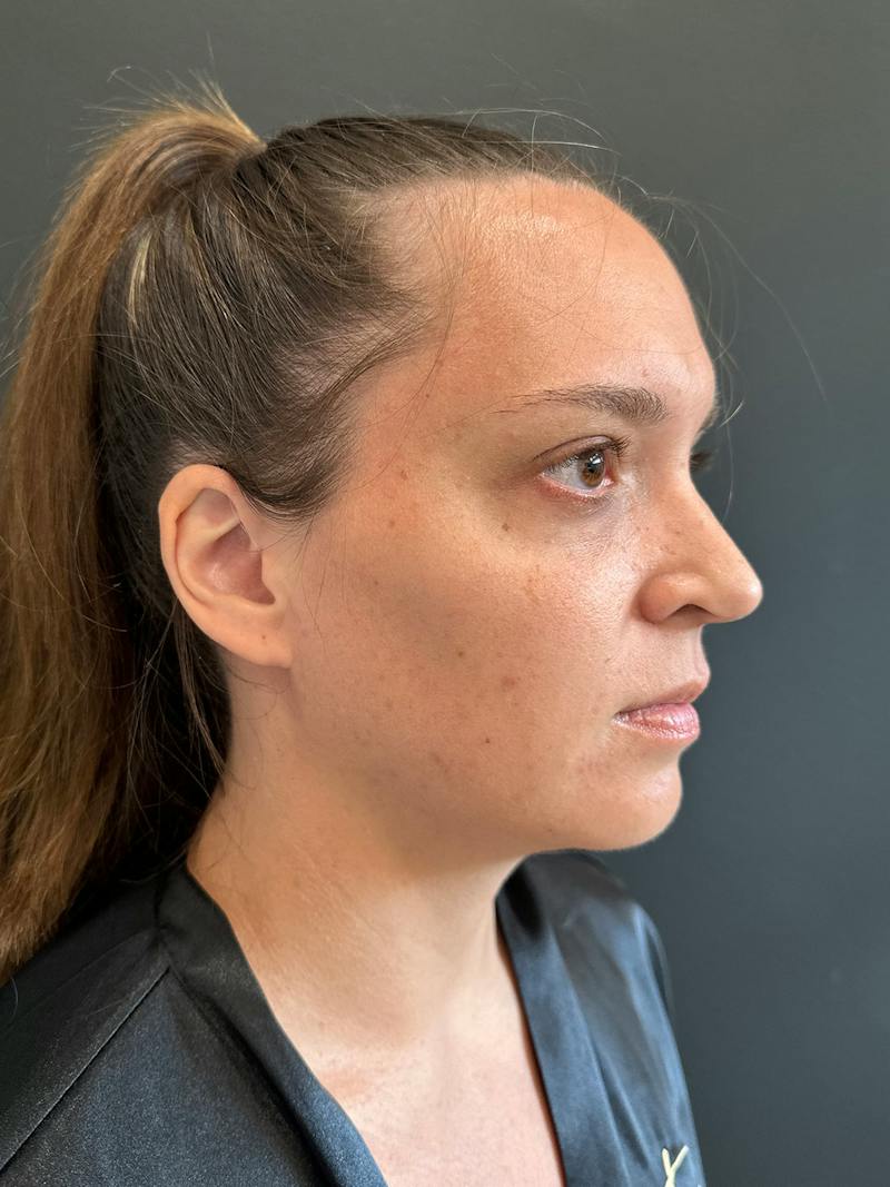 Mommy Makeover Before & After Gallery - Patient 329943 - Image 7