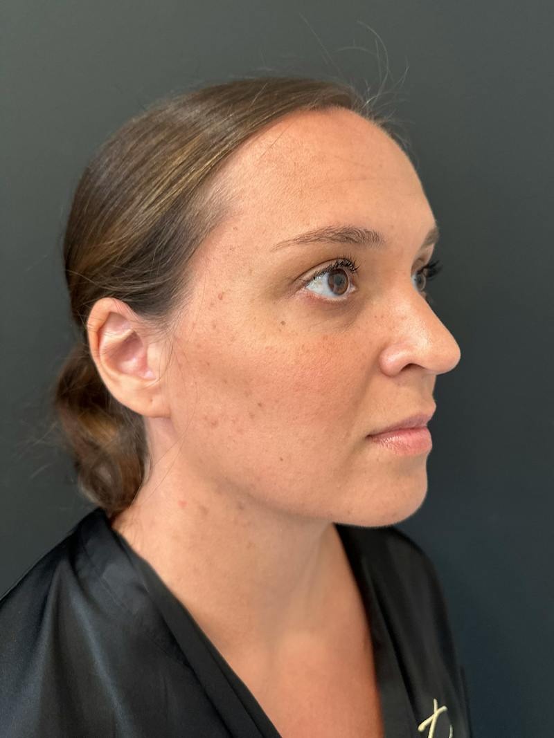 Mommy Makeover Before & After Gallery - Patient 329943 - Image 8