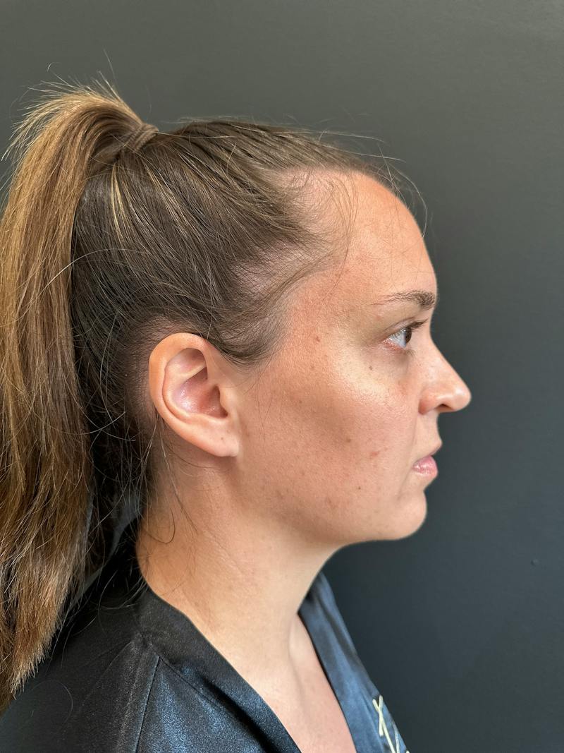 Mommy Makeover Before & After Gallery - Patient 329943 - Image 9