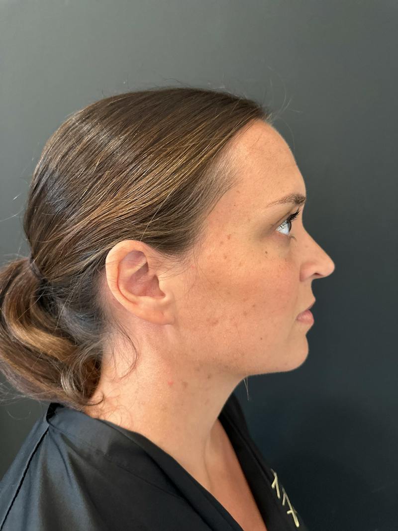 Mommy Makeover Before & After Gallery - Patient 329943 - Image 10