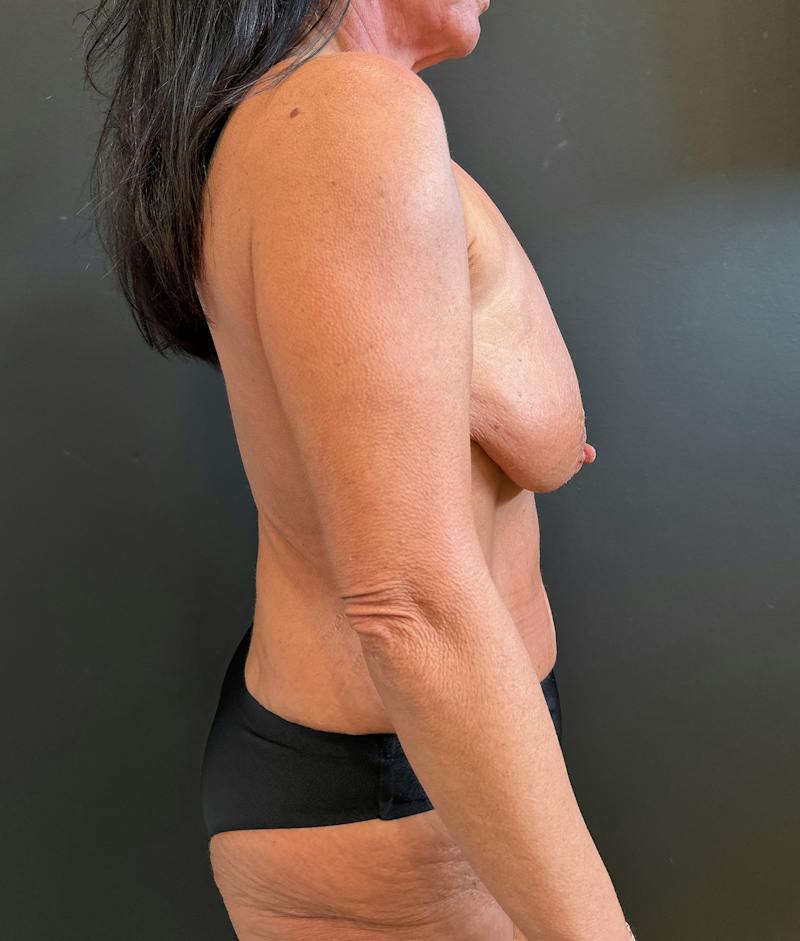 SAFElipo Before & After Gallery - Patient 465783 - Image 3