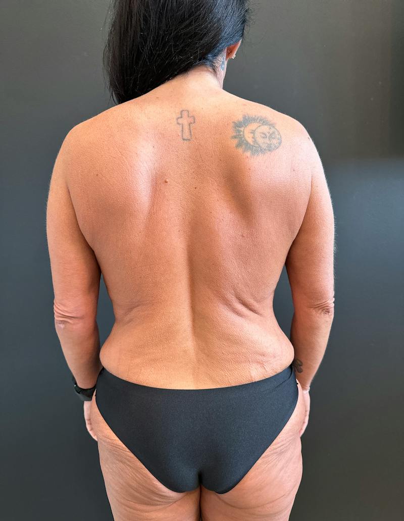 SAFElipo Before & After Gallery - Patient 465783 - Image 9