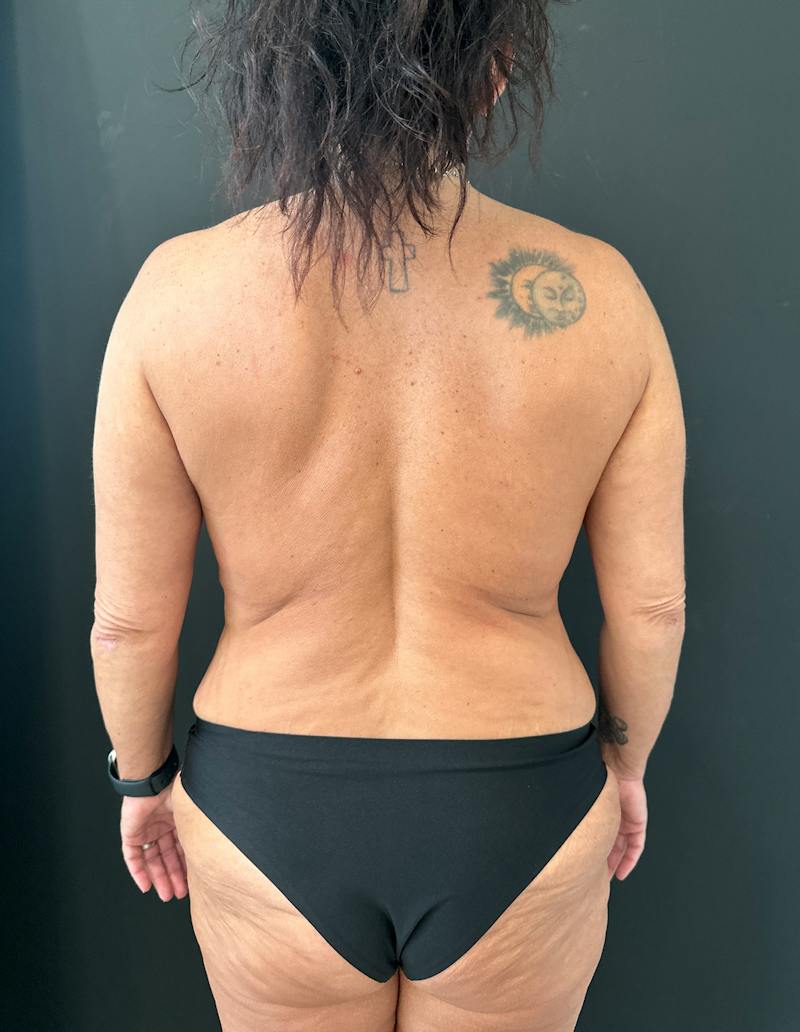 SAFElipo Before & After Gallery - Patient 465783 - Image 10