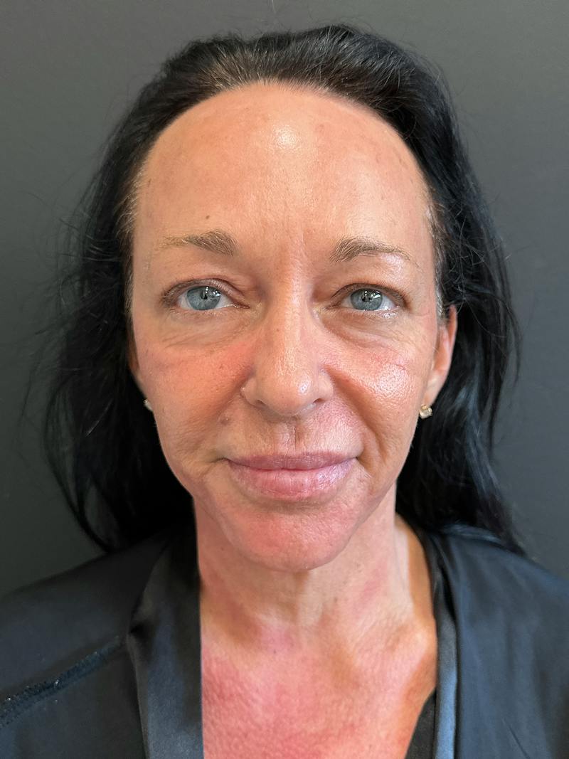 SAFElipo Before & After Gallery - Patient 465783 - Image 11