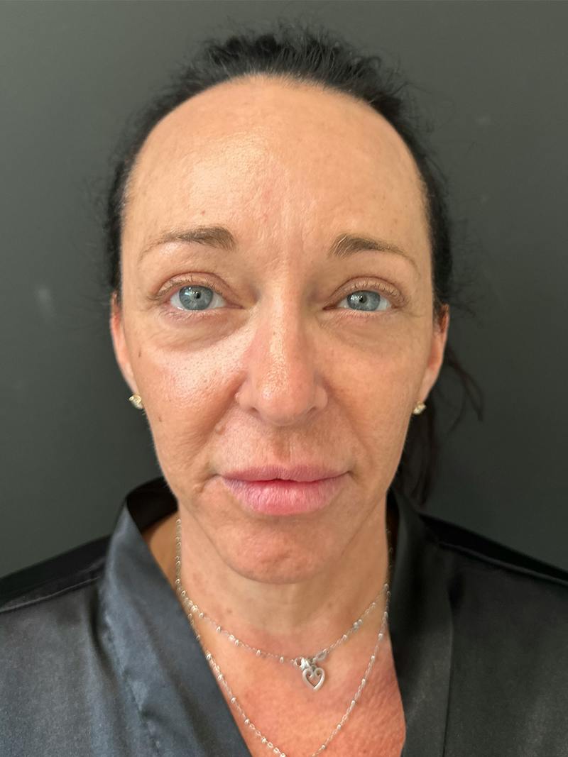 SAFElipo Before & After Gallery - Patient 465783 - Image 12