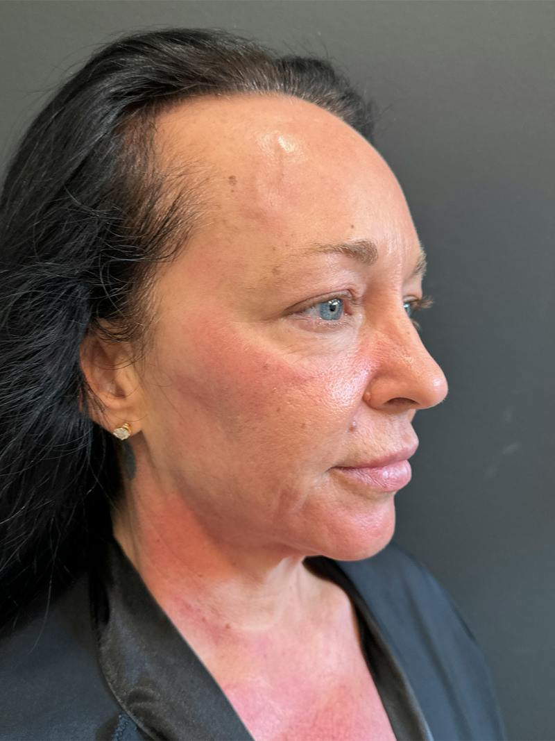 SAFElipo Before & After Gallery - Patient 465783 - Image 13