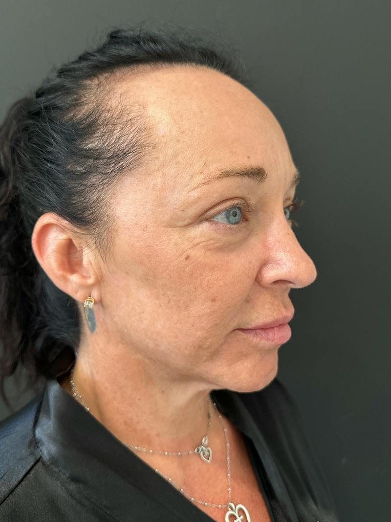 SAFElipo Before & After Gallery - Patient 465783 - Image 14