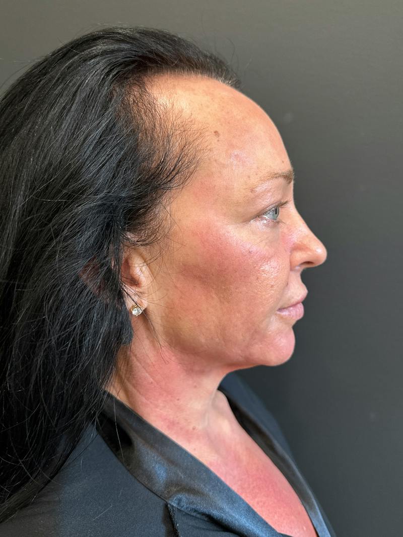 SAFElipo Before & After Gallery - Patient 465783 - Image 15