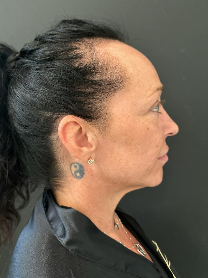 SAFElipo Before & After Gallery - Patient 465783 - Image 16