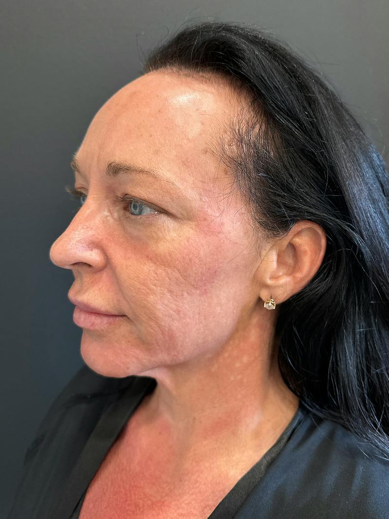 SAFElipo Before & After Gallery - Patient 465783 - Image 17