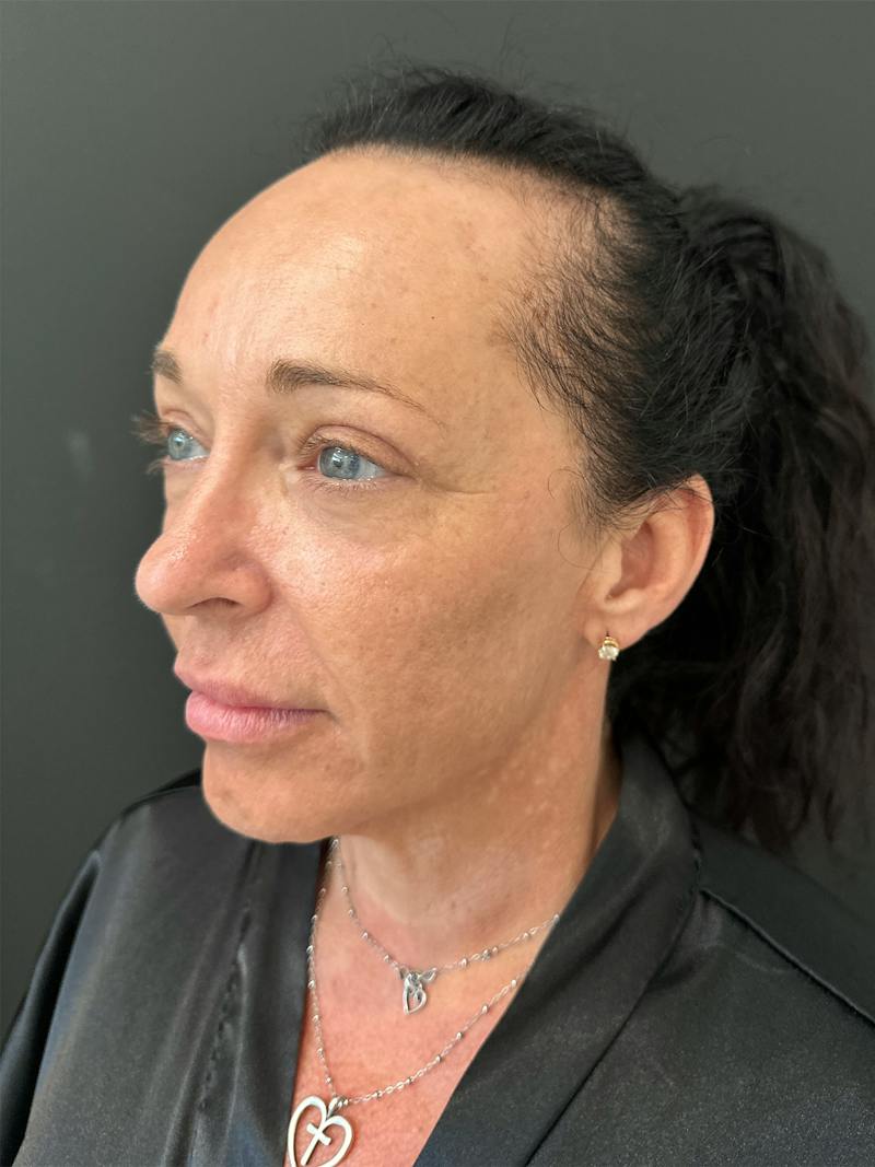 SAFElipo Before & After Gallery - Patient 465783 - Image 18