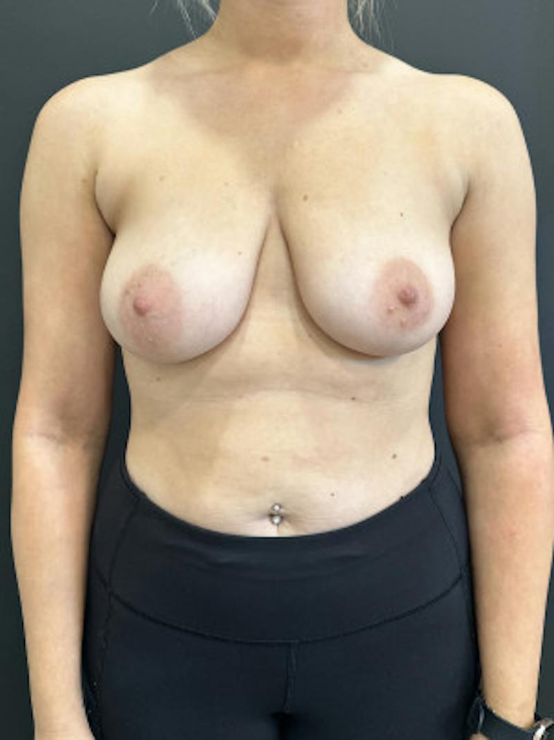 Breast Lift w/ Augmentation Before & After Gallery - Patient 345609 - Image 1