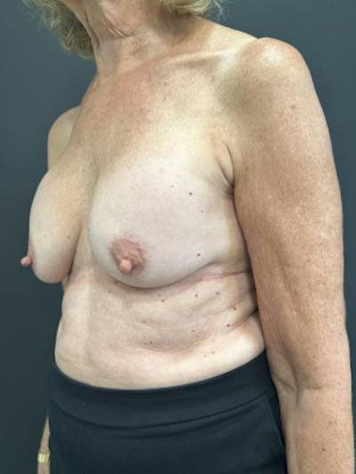 Breast Lift w/ Augmentation Before & After Gallery - Patient 250762 - Image 1