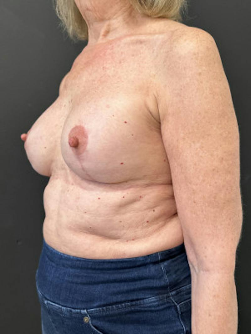 Breast Lift w/ Augmentation Before & After Gallery - Patient 250762 - Image 2