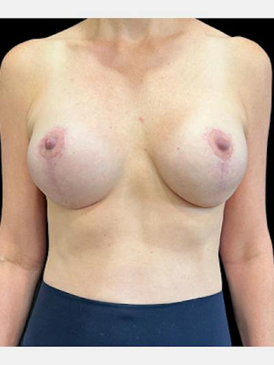 Breast Lift w/ Augmentation Before & After Gallery - Patient 142454 - Image 2