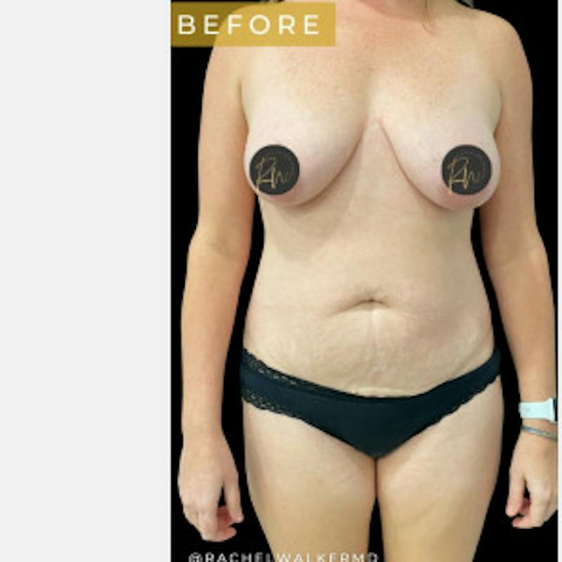 Breast Lift w/ Augmentation Before & After Gallery - Patient 629926 - Image 1