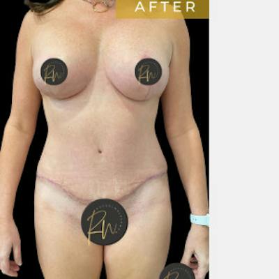 Breast Lift w/ Augmentation Before & After Gallery - Patient 629926 - Image 2