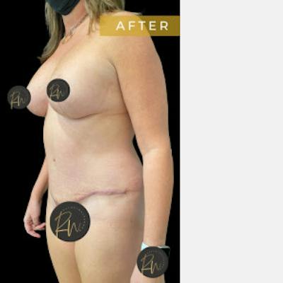 Abdominoplasty (Tummy Tuck) Before & After Gallery - Patient 344329 - Image 2