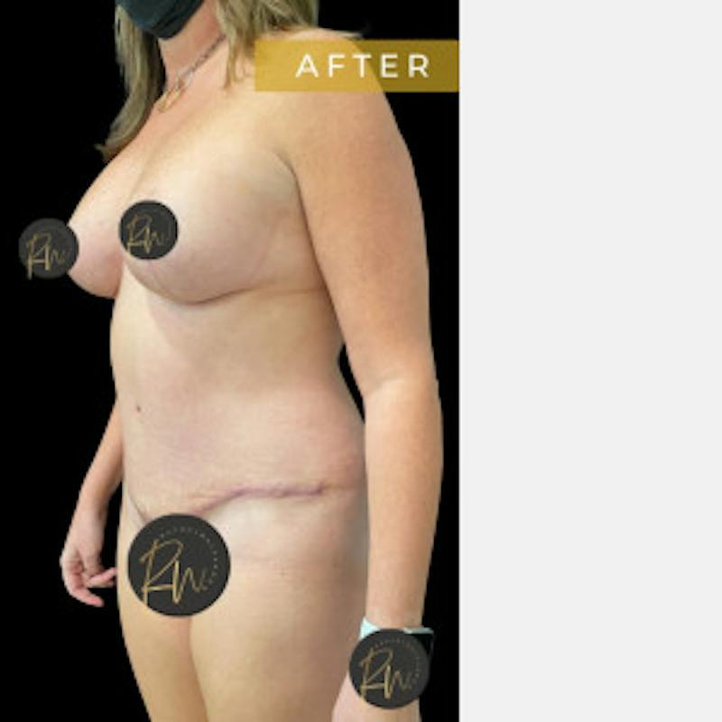Mommy Makeover Before & After Gallery - Patient 386164 - Image 2