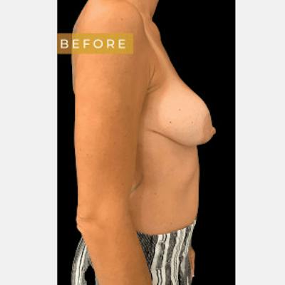 Breast Revision/Correction Before & After Gallery - Patient 499976 - Image 1