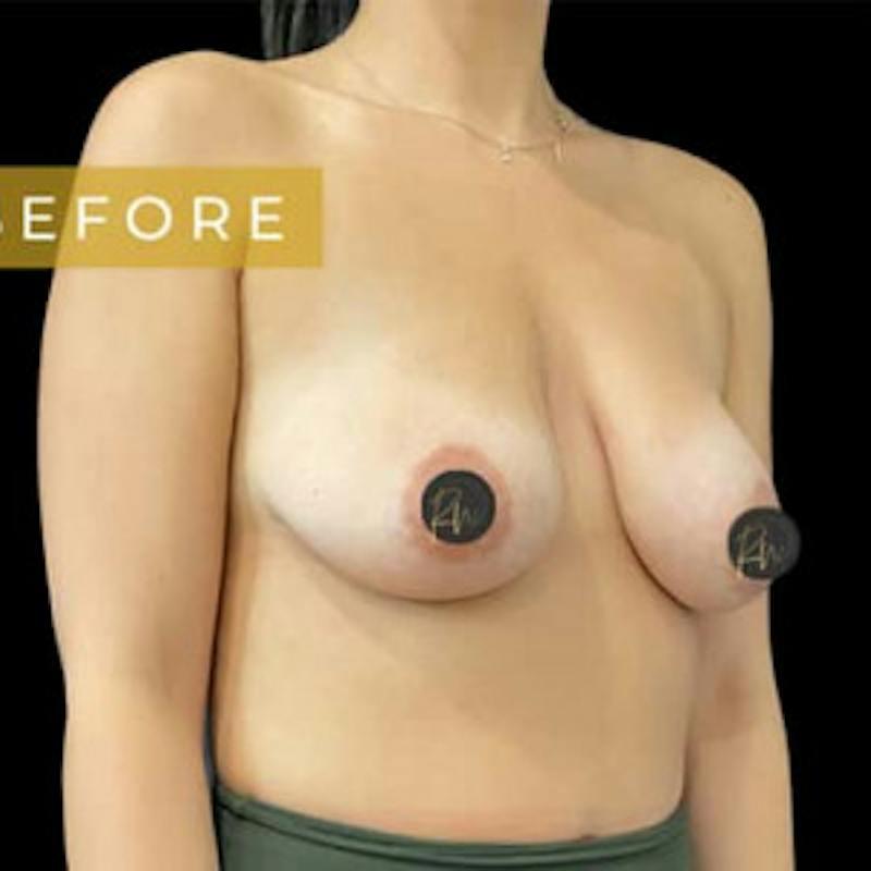 Breast Lift w/ Augmentation Before & After Gallery - Patient 115428 - Image 1