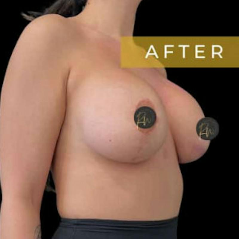 Breast Lift w/ Augmentation Before & After Gallery - Patient 115428 - Image 2