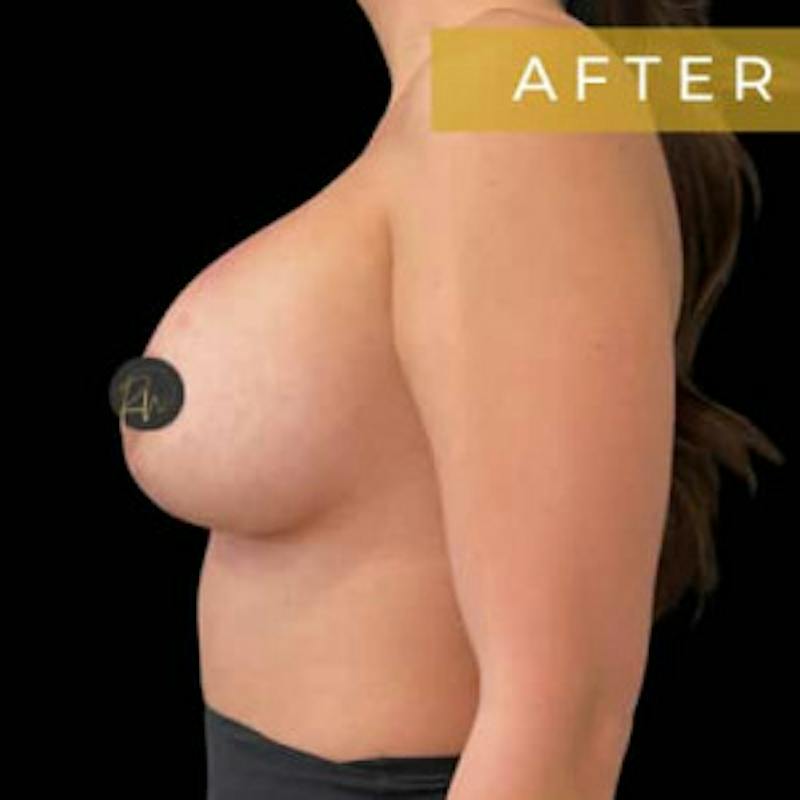 Breast Lift w/ Augmentation Before & After Gallery - Patient 115428 - Image 4