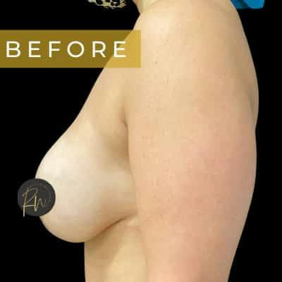 Breast Revision/Correction Before & After Gallery - Patient 132232 - Image 1