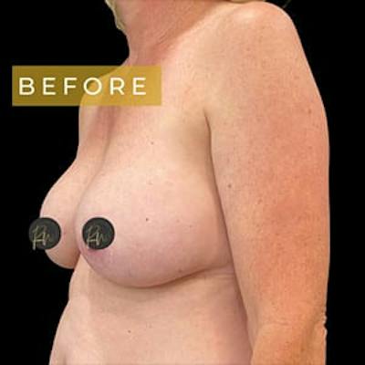 Breast Lift w/ Augmentation Before & After Gallery - Patient 384875 - Image 1