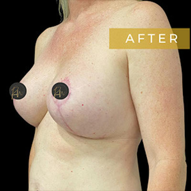 Breast Lift w/ Augmentation Before & After Gallery - Patient 384875 - Image 2