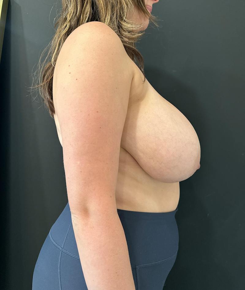 Breast Asymmetry Before & After Gallery - Patient 329970 - Image 5
