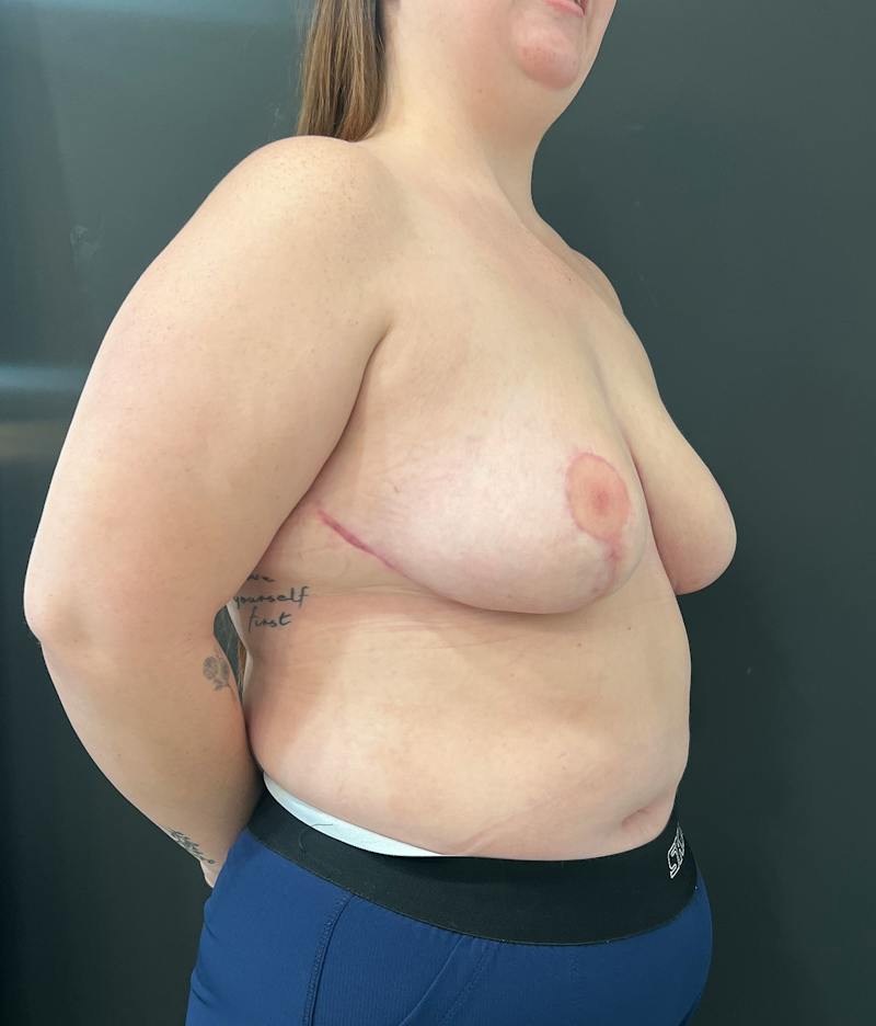 Breast Asymmetry Before & After Gallery - Patient 144861 - Image 4